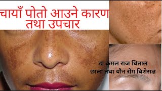 चायाँ पोतोको उपचार | poto hataune upaya | chaya poto kasari hataune| melasma  treatment in nepal