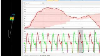 Treadmill   Patient Walking with Freestep Foot Pressure and Video Integration Software screenshot 3