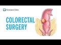 Colorectal Surgery | Cleveland Clinic