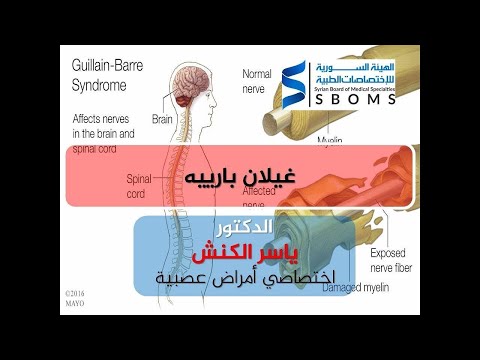 متلازمة غيلان باريه Guillain-Barré syndrome II