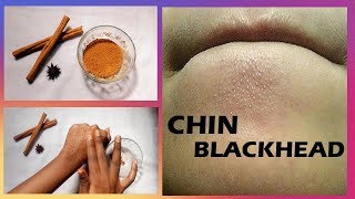 How to get rid of chin blackhead | Cinnamon & honey