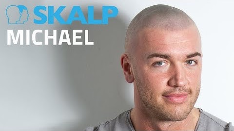 "Take Me Out" star has scalp micropigmentation at Skalp®. Watch Michael’s video.