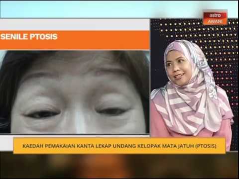 Video: Bagaimana untuk mengurut kelopak mata bawah selepas blepharoplasty?