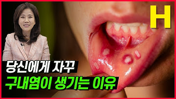 입병 자주 나는 사람 주목! 구내염 자주 난다면 이렇게 해보세요! 구내염 없애는 비법