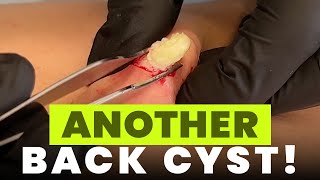 ANOTHER BACK CYST!