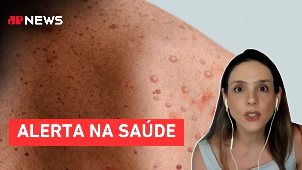 Surto de Mpox: Brasil registra 48 casos, 41 só em SP; infectologista comenta