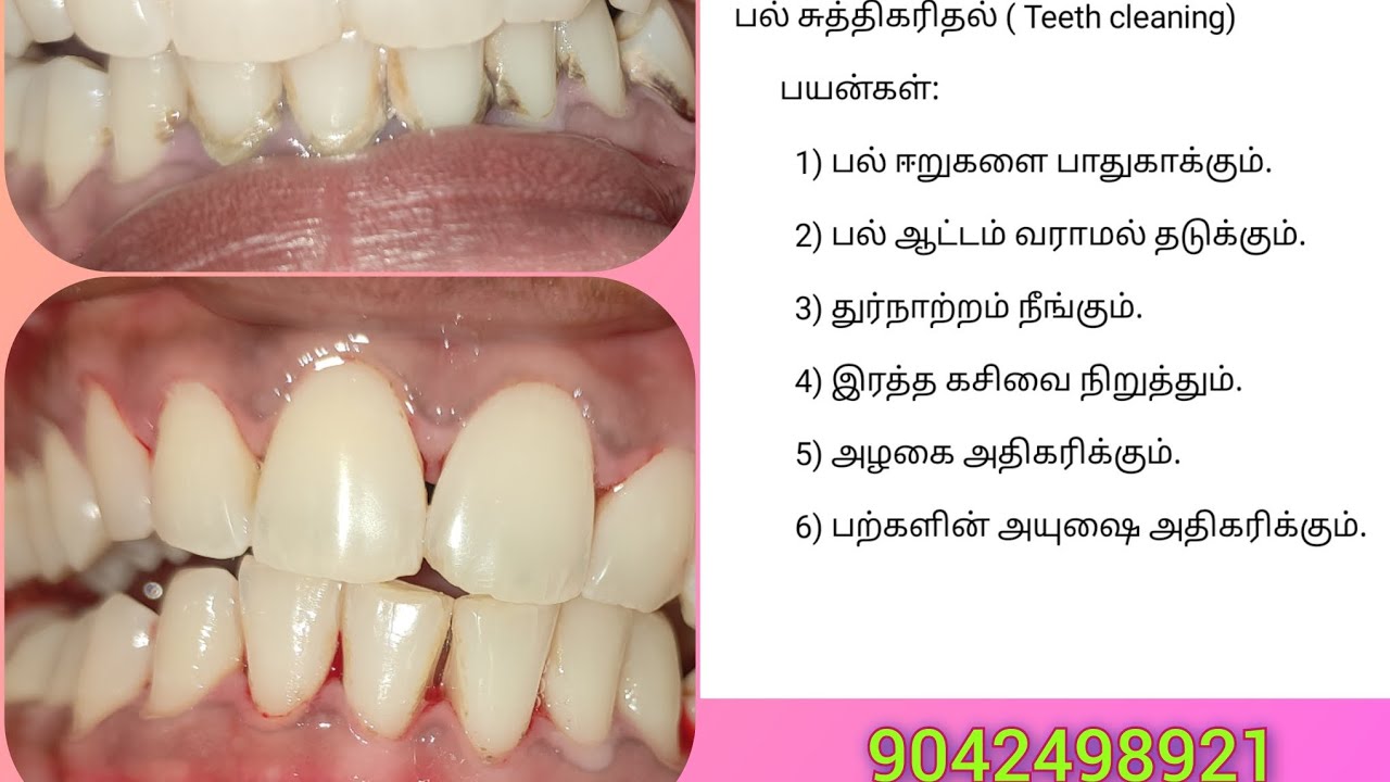 Dental Scaling teeth cleaning Removing dirt around tooth removing