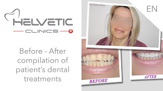 Before - After Compilation - Helvetic Clinics, Dental Clinic Abroad.