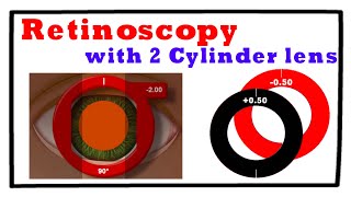 Retinoscopy with 2 Cylinder Trial Lenses (Technique 3) screenshot 4