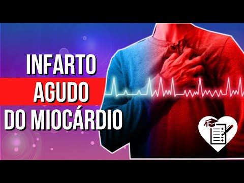 Vídeo: Infarto Agudo Do Miocárdio: Causas, Sintomas E Tratamento