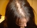 DermTV - Abnormal Hair Loss in Women [DermTV.com Epi #235]