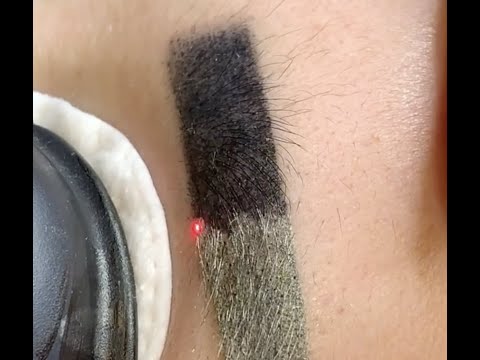 Процедура удаления татуажа бровей лазером 1