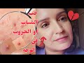 للتخلص من للحبوب في الوجه او حب الشباب X منتجات باليا دم 