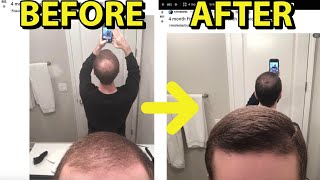 Hair Loss REVERSAL in HYPER-RESPONDER *INSANE* 4 Month Results (Fin+Min+Microneedling)