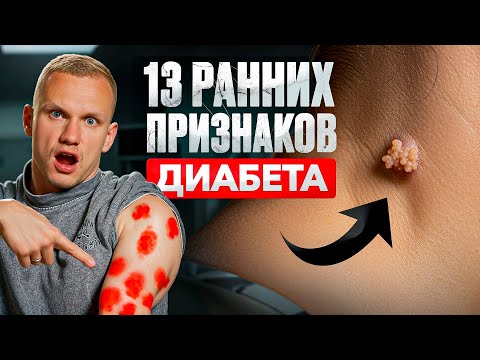 Еще не ДИАБЕТ, но... 13 неявных признаков повышенного САХАРА в КРОВИ