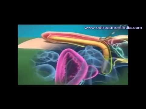 Penile Implant Surgery Treatment India Producer With Animation Videos