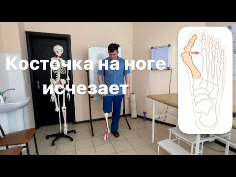 Косточка на большом пальце ноги. Сделал вечером проснулся с утра ее нет. Плоскостопие. Вальгус