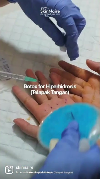Tak hanya untuk kosmetik, Botox dapat atasi keringat berlebihan di telapak tangan! #Hiperhidrosis