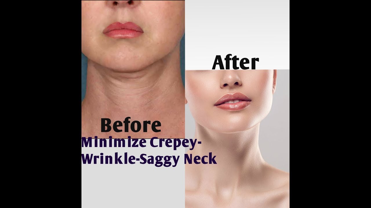 Brilliant detailed information to TIGHTEN a "Saggy Neck" at any AGE