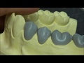 Live wax up - Lower 2nd premolar (full)
