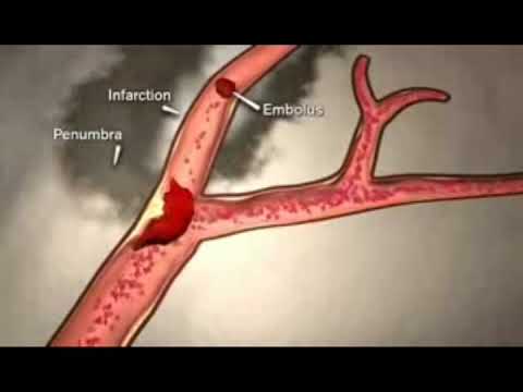 სისტემური თრომბოლიზისი-იშემიური ინსულტის მკურნალობა