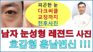 자연스러운 남자 눈성형 레젼드 사진-두꺼운 쌍꺼풀 교정-다크써클교정