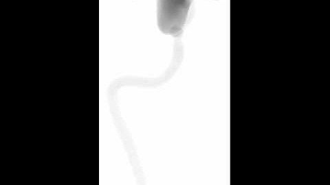 Virtual angiography of a cerebral aneurysm CFD model