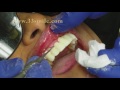 Dental Crowns and Bridges Procedure at Cosmetic Dental Associates in San Antonio, TX