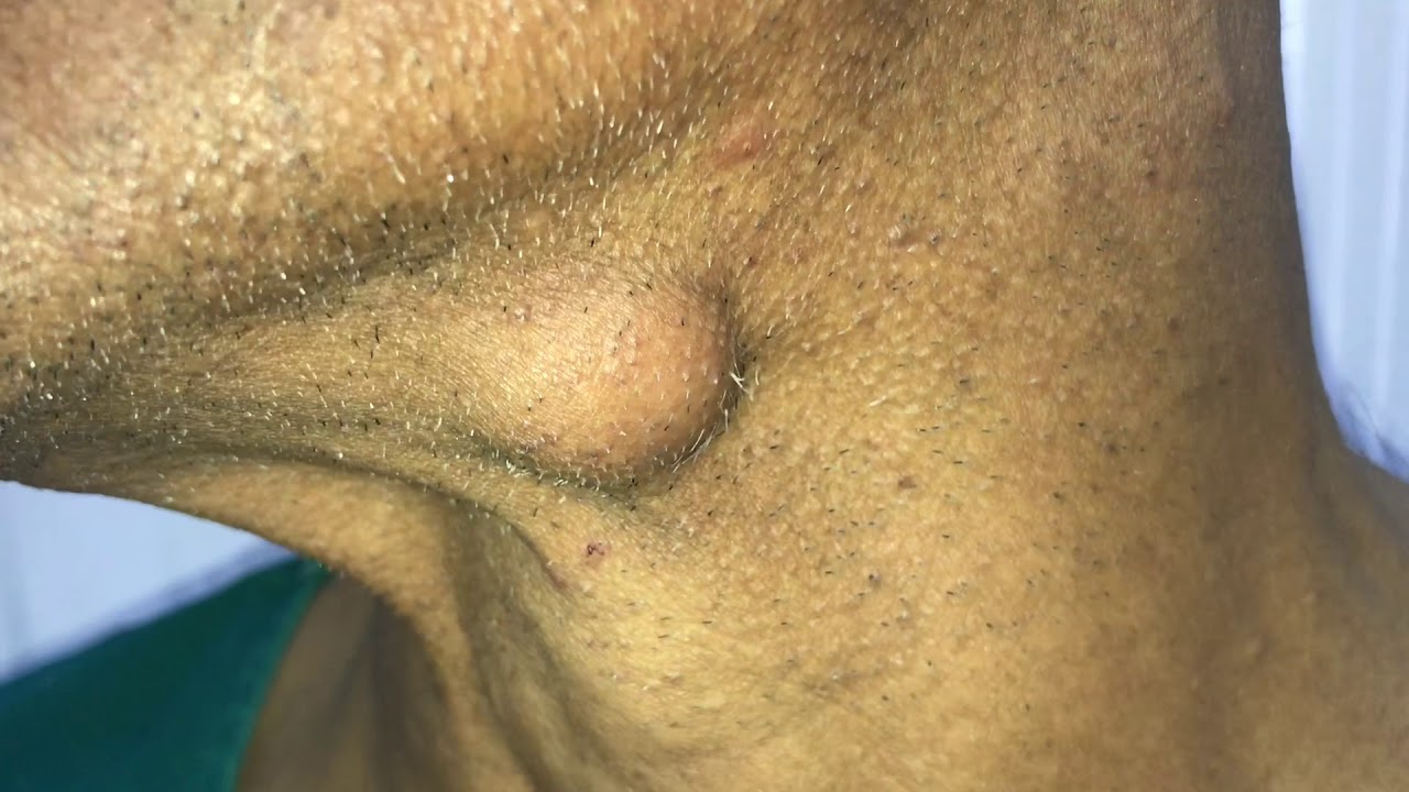 Sebaceous Cyst Excision Video