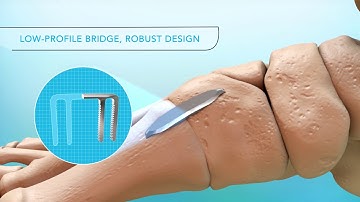 DynaClip Forte® Bone Fixation System - Animation
