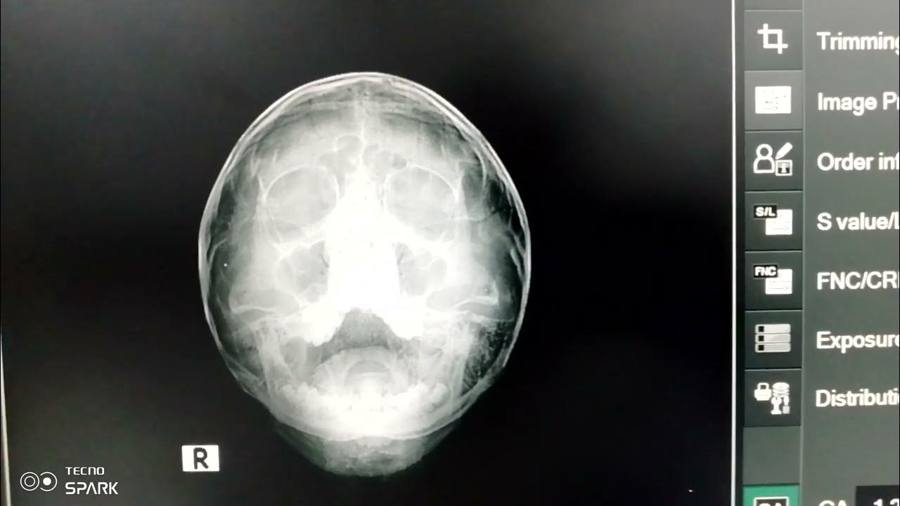 X Ray PNS Waters View On CR Digital System