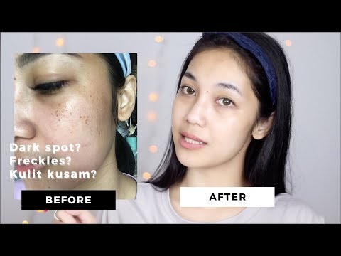 Pengalaman menghilangkan flek hitam dengan laser dan skincare routine ku!