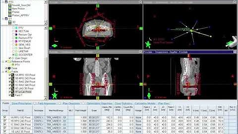 4 Beam Arrangement and Planning Templates for Prostate IMRT
