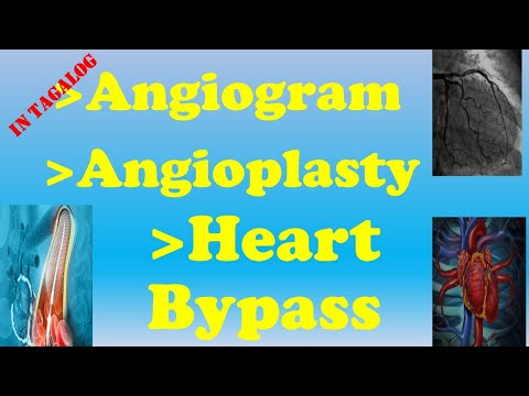 Ano ang Angiogram, Angioplasty, at Heart Bypass?