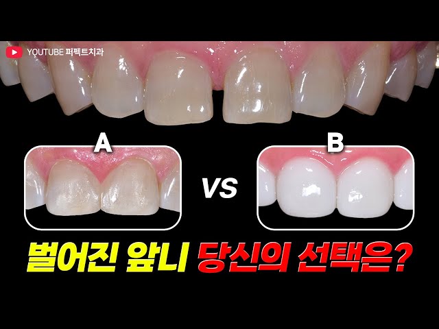벌어진 앞니 레진vs라미네이트 뭐가 더 좋을까? 각각 비교👀