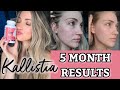 Kallistia Acne Cleanse Review + 5 Month Results