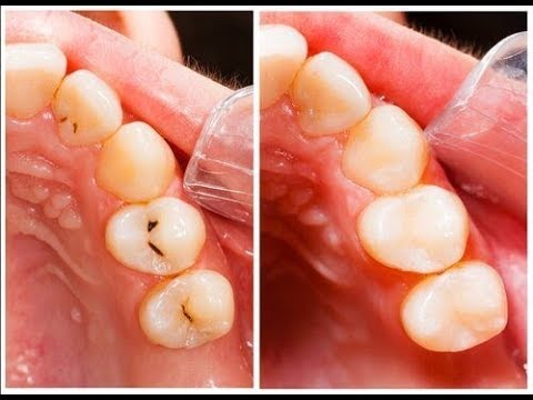 Video: 3 maniere om tandbederf om te keer