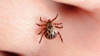 The Correct Way to Handle Tick Bites | Dr. Drew Sinatra