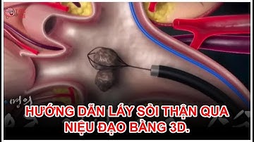 Hướng dẫn lấy sỏi thận qua niệu đạo bằng 3D.