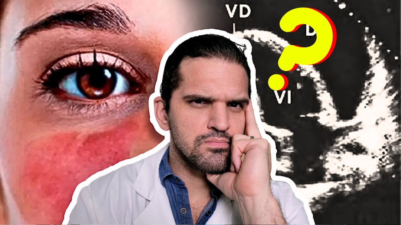 ¡INCREIBLE! Esta fue la CAUSA de PERICARDITIS y DERRAME en una JOVEN 😮