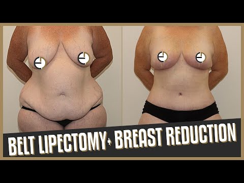 Belt Lipectomy and Breast Reduction