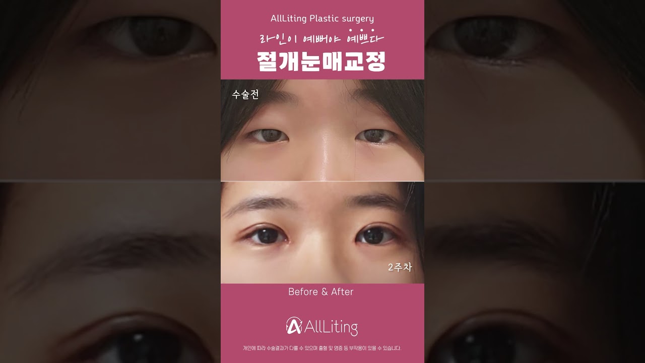 [奧利廷整形外科診所] 如果您想獲得確切的改變，當然還是選擇奧利廷 #切開式眼瞼下垂矯正手術 😻 #切開式眼瞼下垂矯正推薦診所 #切開式眼瞼下垂矯正心得 #切開式眼瞼下垂矯正Vlog #切開式眼瞼下垂矯正專業診所