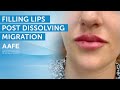 Filling Nora's Lips Five Weeks Post Dissolving Migrated Filler! | AAFE