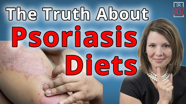 Understanding Psoriasis & the Truth About Psoriasis Diet - Dr. Boz