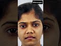Rhinoplasty journey