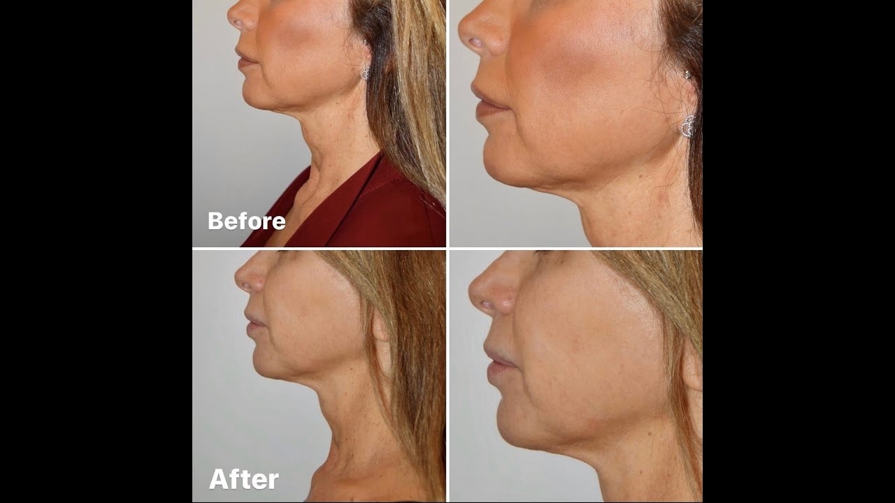 What is Morpheus8? | Dr. David P. Rapaport NYC