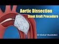 Aortic Dissection Stent Graft Procedure
