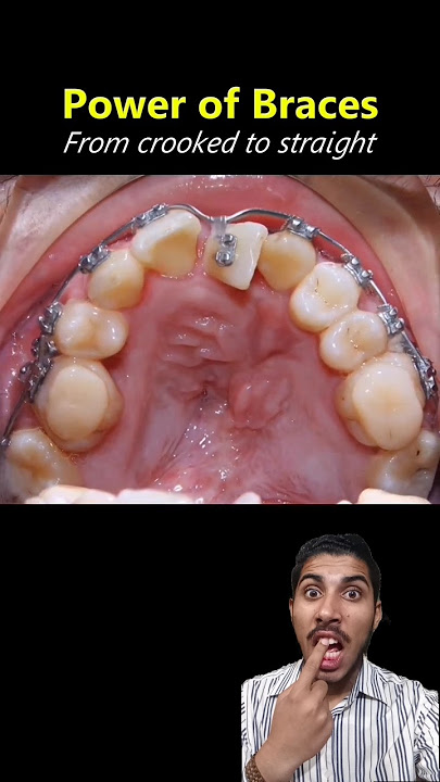 braces treatment process 😱👀😬 #trending #foryou #shorts #fypシ゚viral