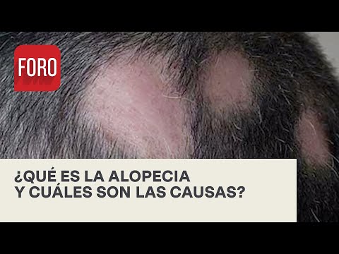 Video: Cosa causa l'alopecia diffusa?