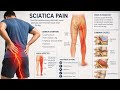 Sciatica pain/nerve pain/non surgical treatment of back and leg pain